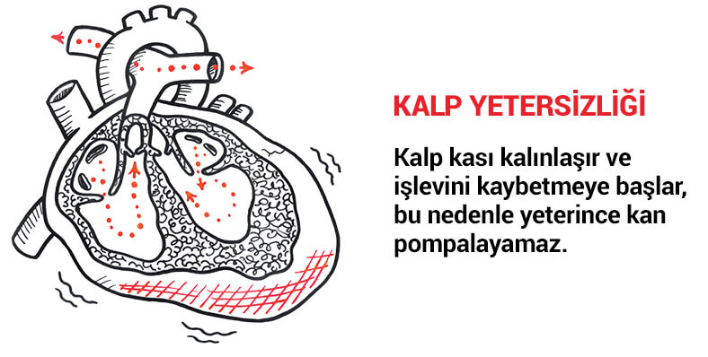 Kalp yetersizliği