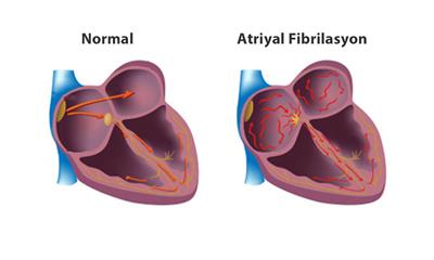 atrial fibrilasyon