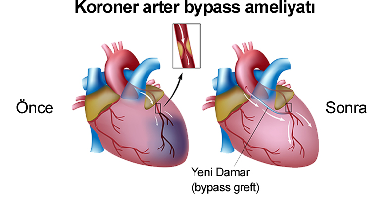 Koroner arter bypass ameliyatı